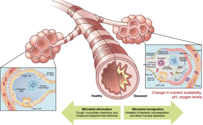 The changing microbiome in cystic fibrosis: a key to diagnosis and ...